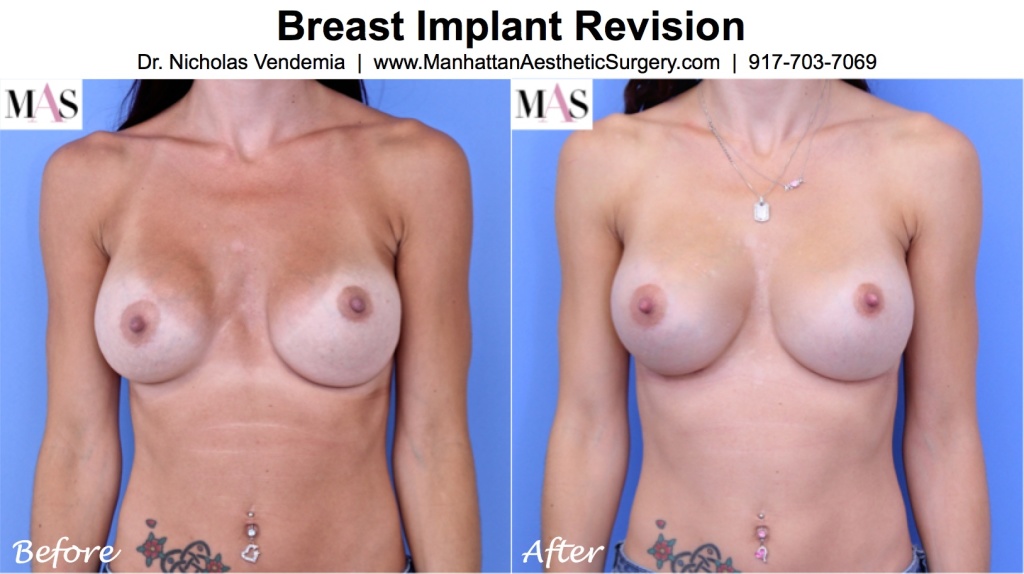 Breast-Revision-18-1024x574