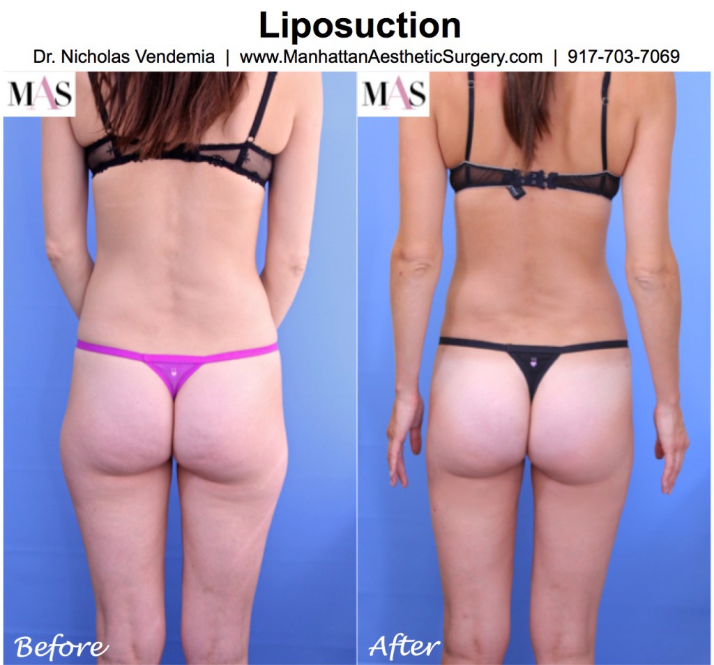 Liposuction-6-Rear-Full