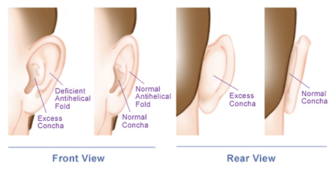 otoplasty-ear-diagram-v2a1
